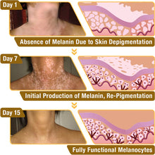 Load image into Gallery viewer, BeeVenom Vitiligo Treatment Cream
