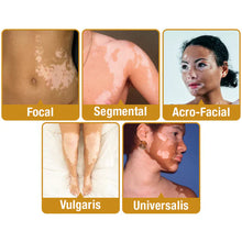 Load image into Gallery viewer, BeeVenom Vitiligo Treatment Cream
