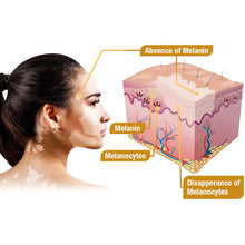 Load image into Gallery viewer, BeeVenom Vitiligo Treatment Cream
