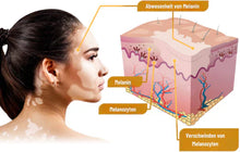Load image into Gallery viewer, Fivfivgo™ BeeVenom Vitiligo Behandlung Creme

