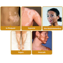 Load image into Gallery viewer, Fivfivgo™ BeeVenom Vitiligo Behandlung Creme
