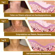 Load image into Gallery viewer, Fivfivgo™ BeeVenom Vitiligo Behandlung Creme
